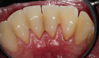 Pacient se zánětem dásní a zubním kamenem - stav před ošetřením